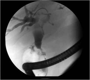 Image of pancreatic duct during an ERCP procedure