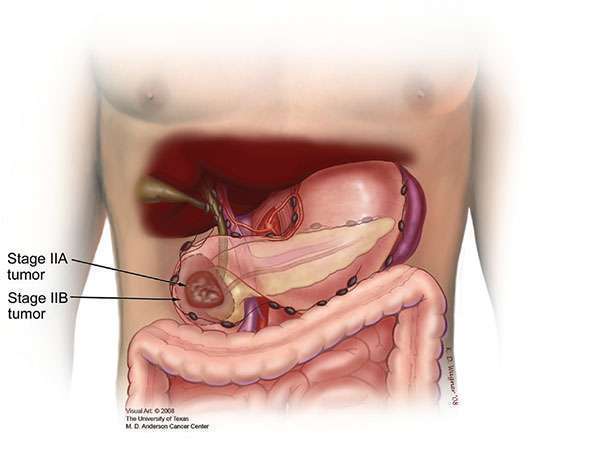 Stage II tumors may or may not extend beyond the pancreas and do not involve the major local arteries.