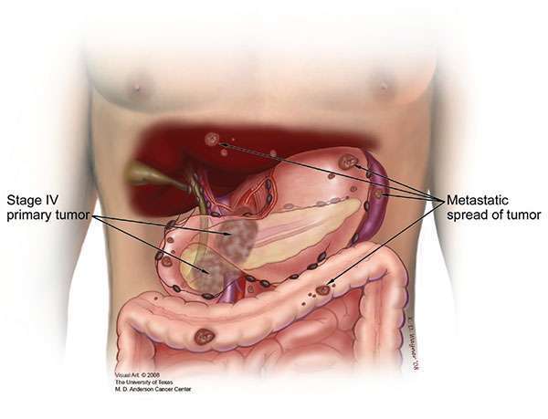 pancreatic cancer definition