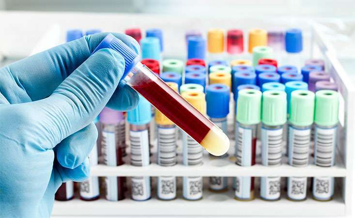 Blood is tested for CA 19-9 levels in a lab