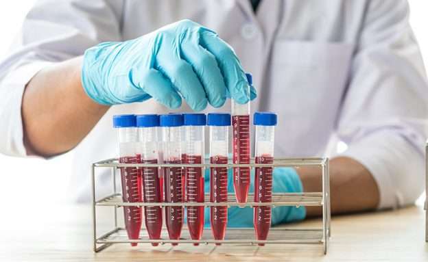 Feature image Researcher examines a blood sample for potential pancreatic cancer biomarkers