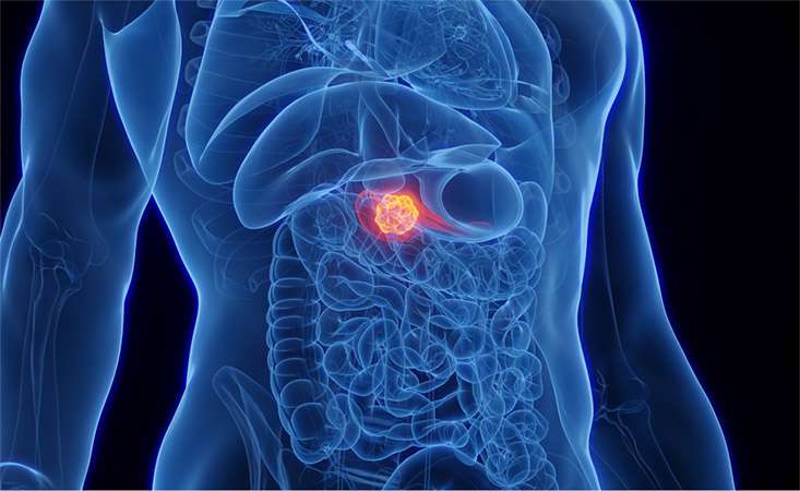 Feature image pancreatic cancer illustration