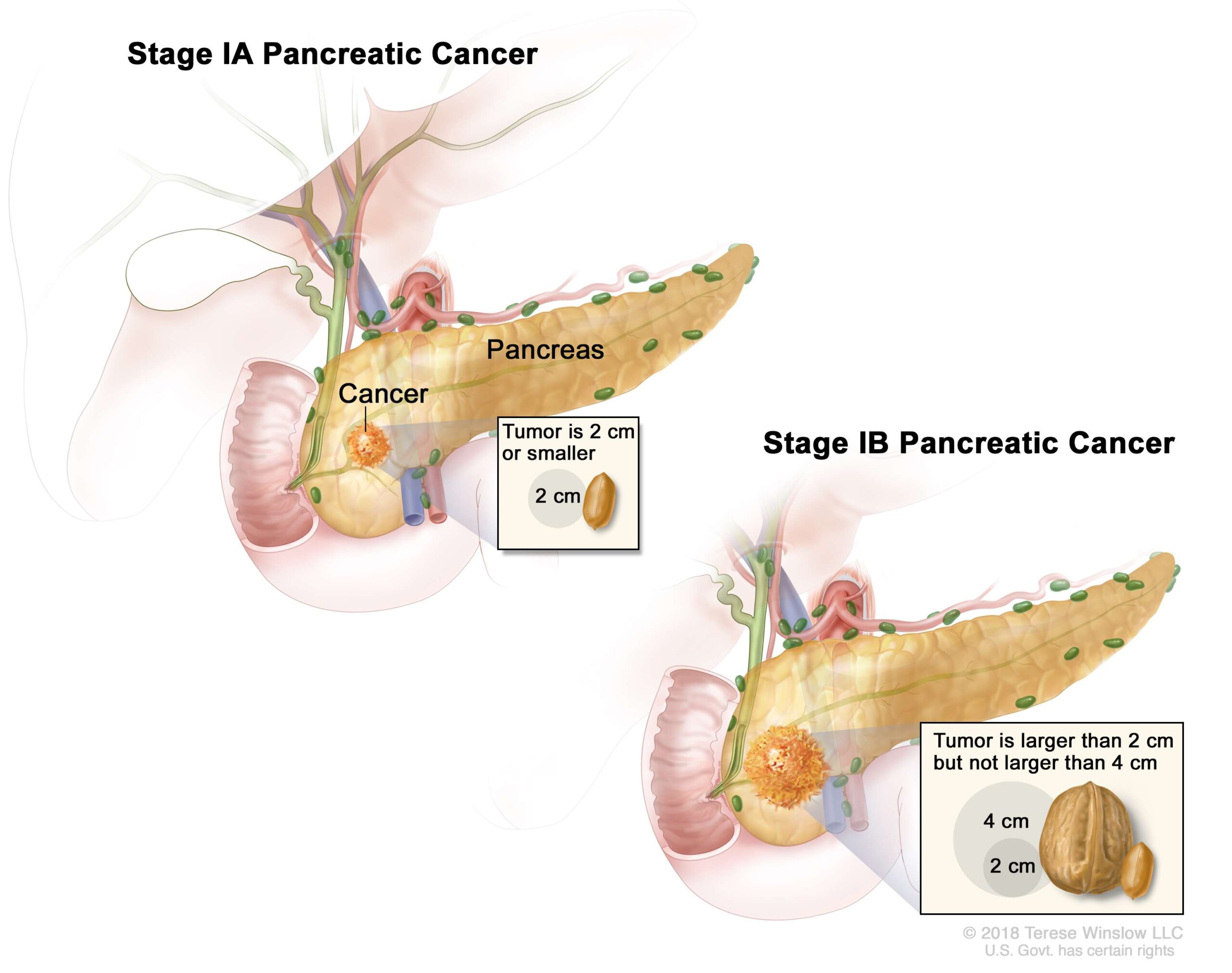 Stage I tumors are limited to the pancreas and can usually be removed by surgery.