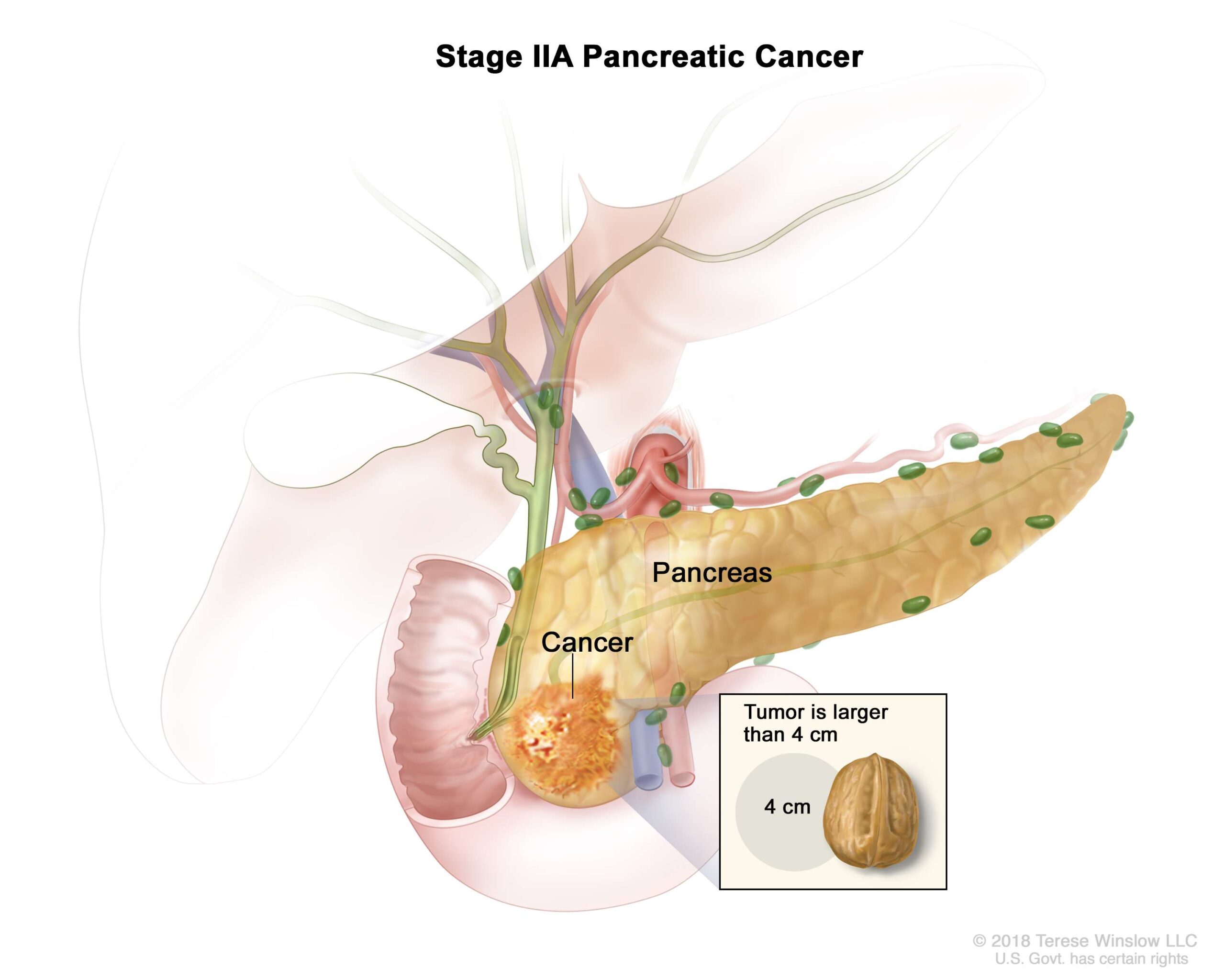 Stage II tumors may or may not extend beyond the pancreas and do not involve the major local arteries.