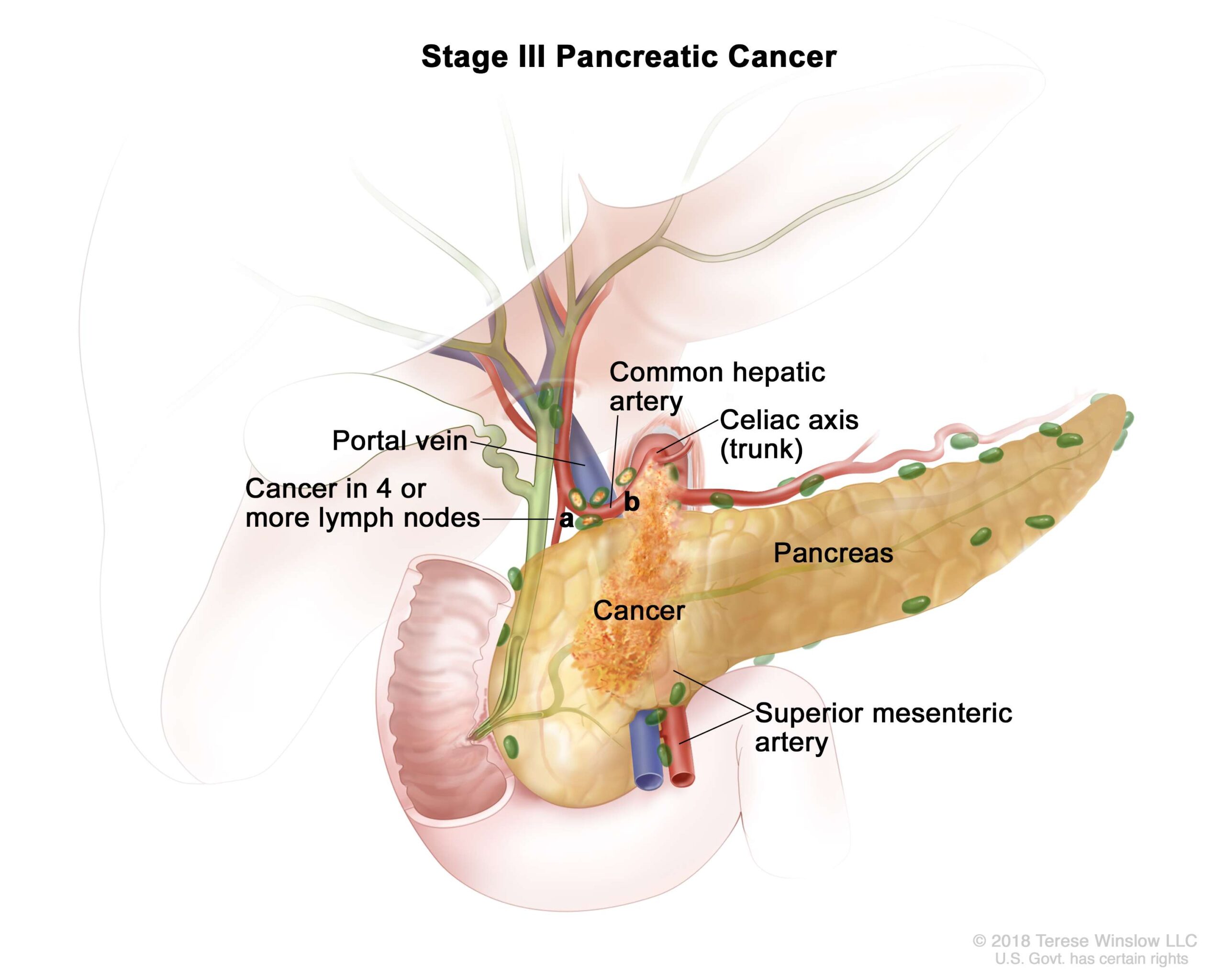 A stage III tumor involves major local arteries. Local lymph nodes may or may not be involved.