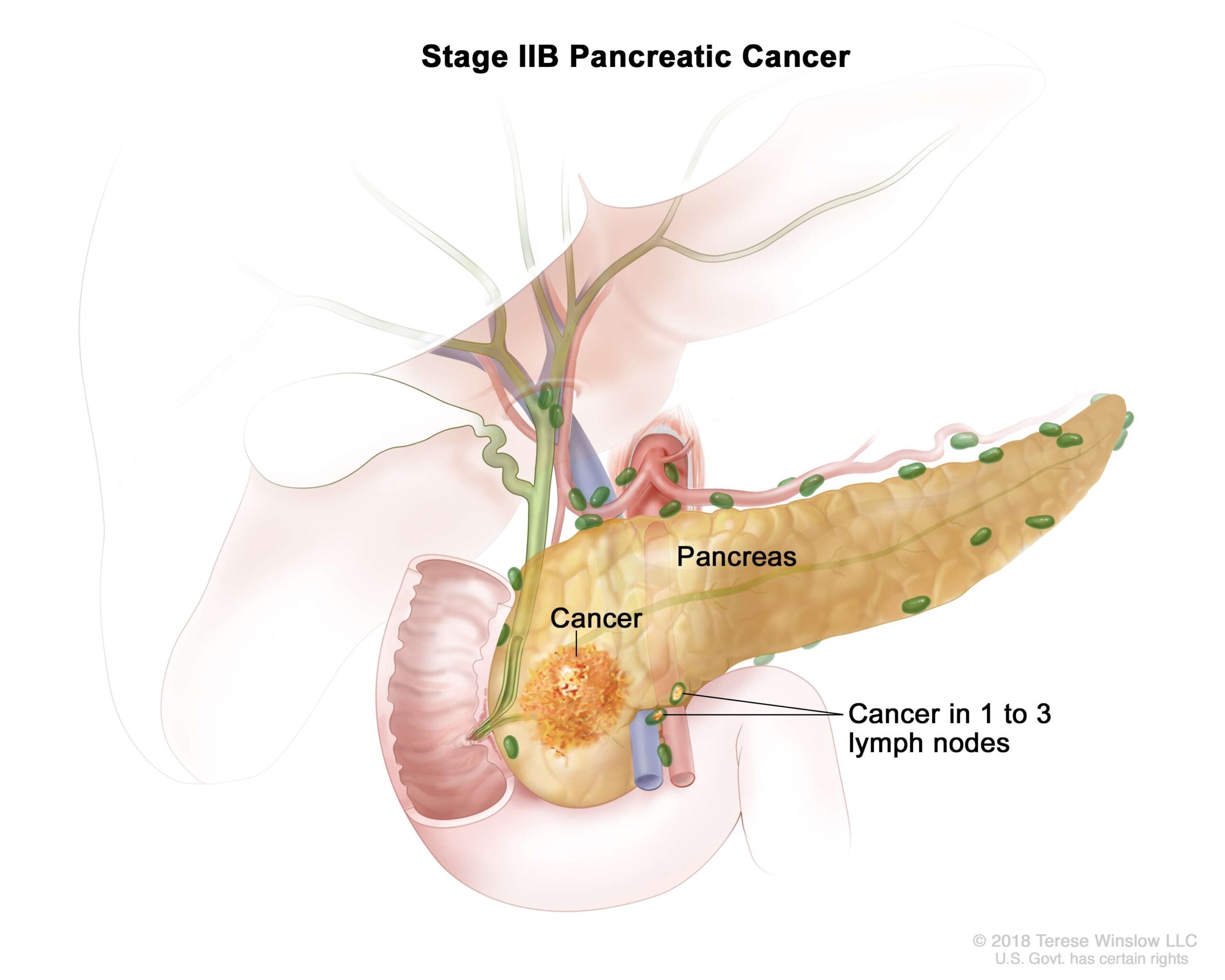 Stage II tumors may or may not extend beyond the pancreas and do not involve the major local arteries.