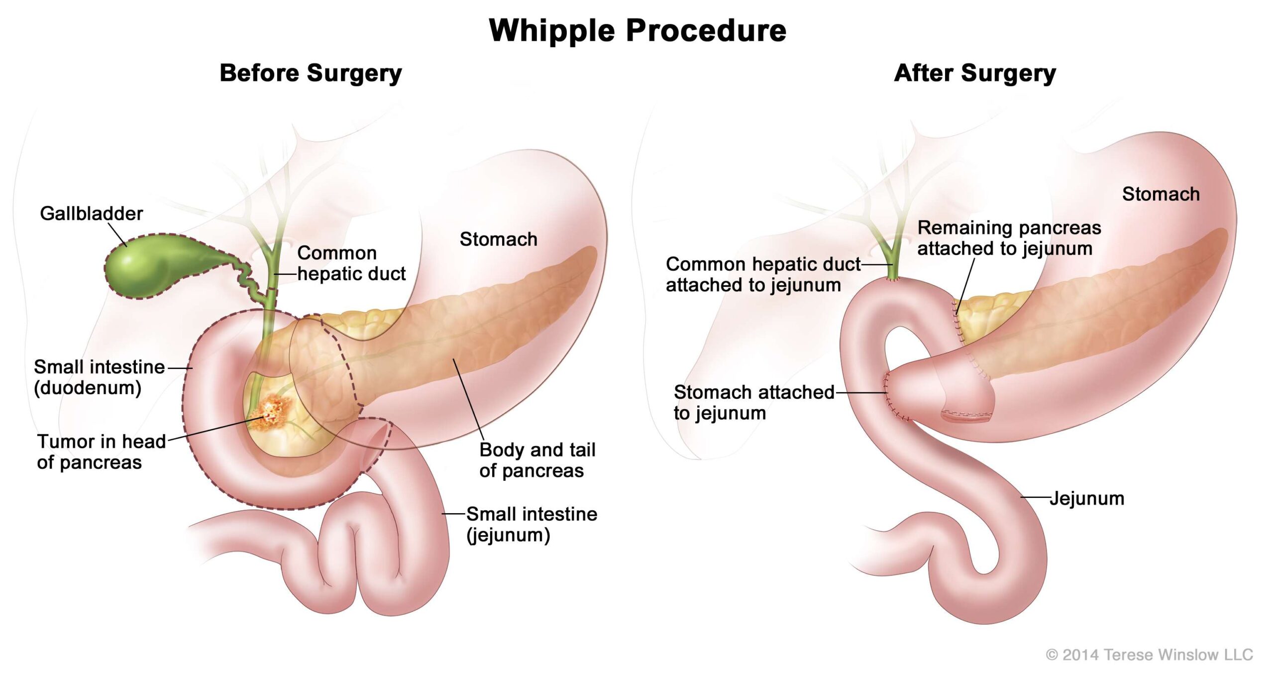 Illustration of abdominal area depicts the head of the pancreas with a tumor before Whipple surgery.